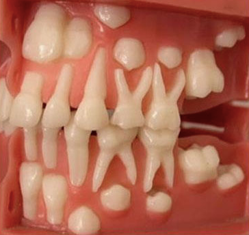 Illustration for article titled PEDIATRIC DENTISTS IN BANGALORE